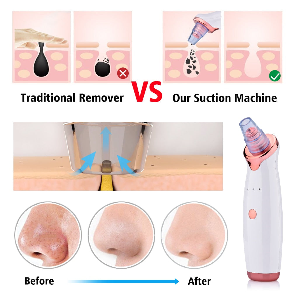 Blackhead Remover